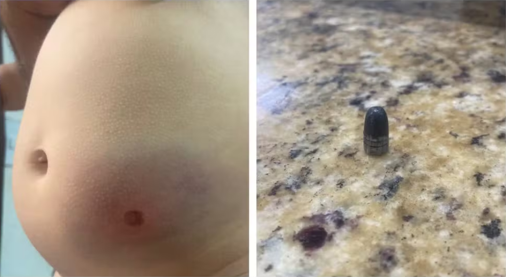 Bebê atingida por bala perdida - Leste Online